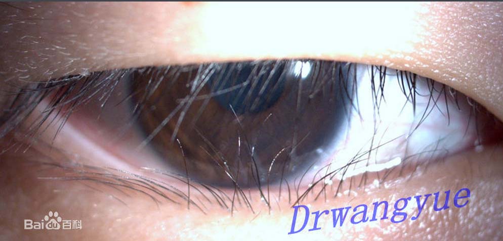 什么是倒睫3.jpg