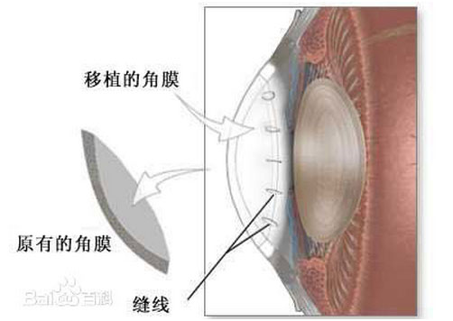 角膜2.jpg
