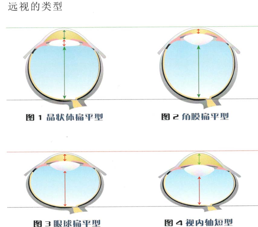 屈光度与眼球的形态-2.jpg