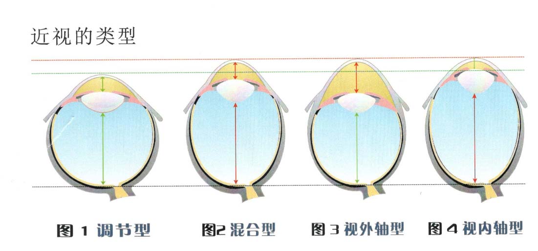 屈光度与眼球的形态-1.jpg