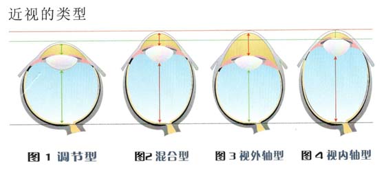 什么是近视.jpg